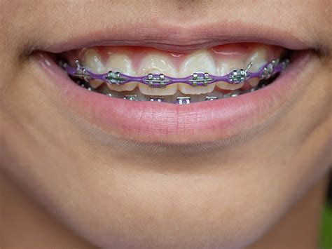 What is the longest reasonable time? How Long Does It Take For Braces To Straighten Teeth ...
