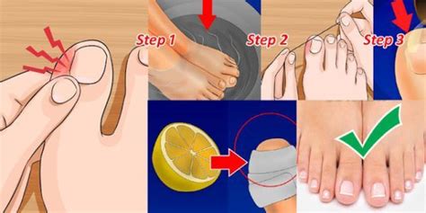 See full list on wikihow.com Pin on Ingrown Hair On Legs