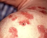 Maybe you would like to learn more about one of these? Syphilis - Ursachen, Symptome, Diagnose und Behandlung