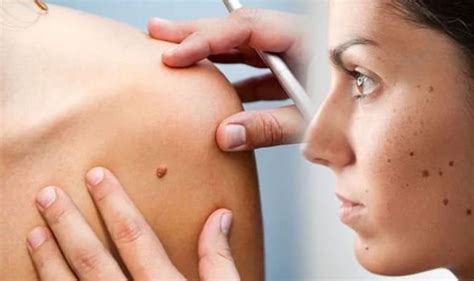 About 8 out of 10 of all skin cancers are basal cell carcinomas (also called basal cell cancers). Skin cancer: Does your mole look like this? Pictures ...