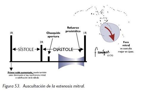 La estenosis mitral es una afección que hace que la válvula mitral se estreche y se torne rígida. Medicina: Enfermedades Cardiacas y Digestivas: Estenosis ...