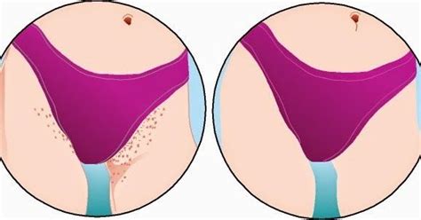 Zeichner impresses upon the importance of a quality aftershave product, dividing the best kinds of. The importance of exfoliating before shaving | Bikini bump ...