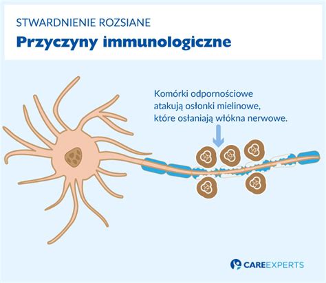 Kampania informacyjna o stwardnieniu rozsianym. Przyczyny stwardnienia rozsianego | Care Experts