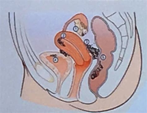 Endometrioza reprezinta cresterea anormala a celulelor endometriale (celulele care se desprind de peretii uterului in fiecare luna la menstruatie) in afara uterului. endometrioza-2 - Poliklinika za ginekologiju i ...