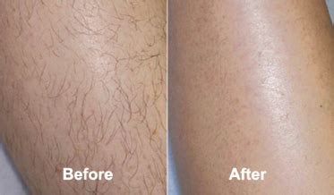 But thank the beauty gods for technological advances. Lucent Skin Hair Removal Cream Reviews - Does It Work?