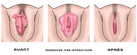 The function of the labia is to protect the clitoris and vagina from trauma. LABIPLASTY in Djerba: