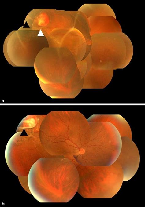 Detachment means that it has pulled away from the layers of tissue around it. Fundus photographs obtained before (a) and after (b ...