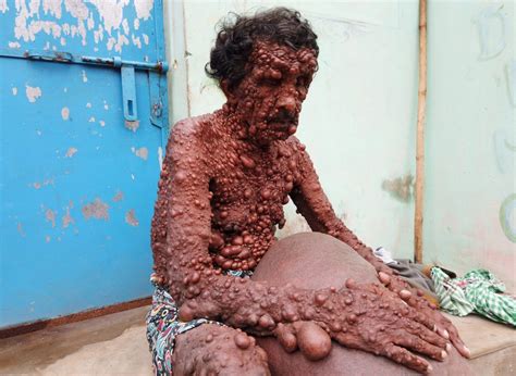 Indian Man With Extremely Rare Skin Disease Is Covered In ...