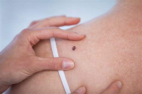 Most skin cancers can be treated successfully when detected at an early stage. What is melanoma and what are the early signs of the skin ...