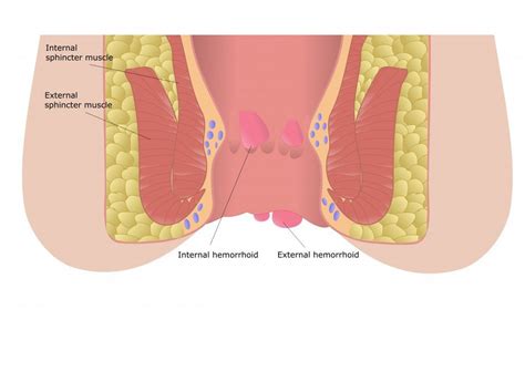 Ab wann kann denn ein frauenarzt im blut erkennen, ob ich schwanger bin, oder kann das der normale hausarzt evtl. Schmerzhafte Hämorrhoiden: Ab wann eine Therapie sinnvoll ...