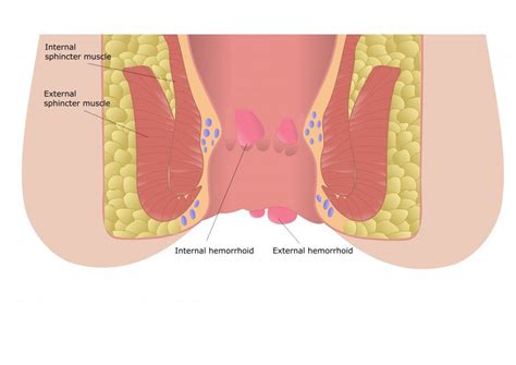 Radioimmunologischer schnelltest für hcg bei normaler und gestörter frühschwangerschaft. Schmerzhafte Hämorrhoiden: Ab wann eine Therapie sinnvoll ...