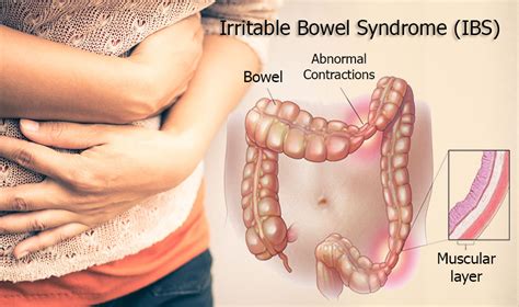 Irritable bowel syndrome (ibs) is a disorder of bowel function (as irritable bowel syndrome has several symptoms. Irritable Bowel Syndrome; Top 42 IBS Questions and Answers