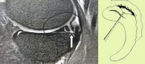 Until recently, the recommended treatments for grades iii and iv hemorrhoids were limited to rubber band ligation (rbl) and conventional hemorrhoidectomy. GENOU - Lésions méniscales | Docteur Franck Schaison ...