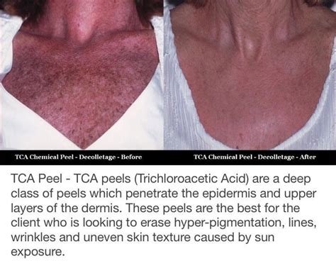Medically, anyone allergic to salicylic acid (this is commonly an allergy to aspirin) or resorcinol is not to use this peel, de sousa warns. Pin on Chemical Peels