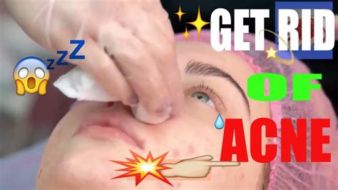 Read my story to see what worked and what changed my life. how to get rid of adult acne - adult acne - late acne ...