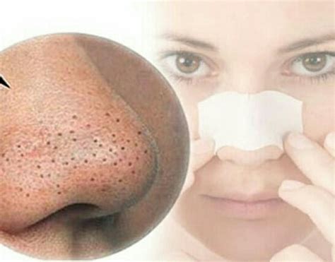 Cara menghilangkan ketombe dengan jeruk nipis. Cara Menghilangkan Whitehead & Blackhead - Cerita Ceriti ...