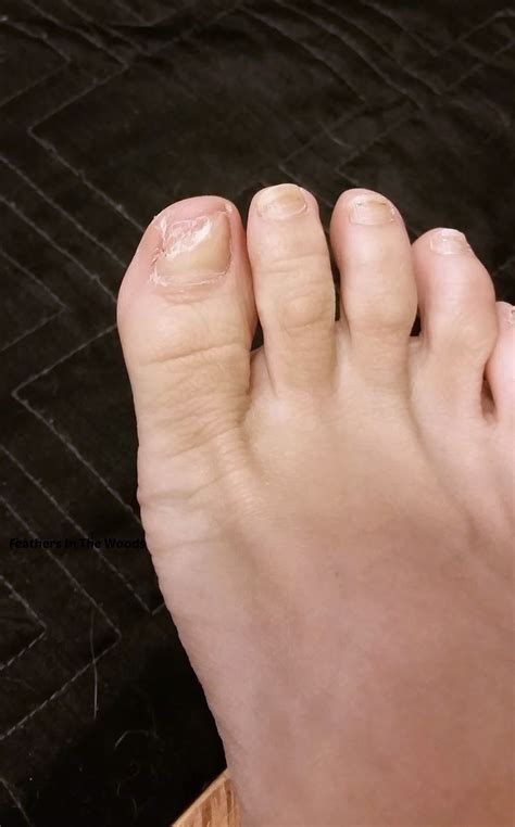 In this article, we will talk about ways to treat nail fungus? How I got rid of toenail fungus (quickly & naturally ...