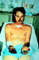 Maybe you would like to learn more about one of these? Pes ( Plague, Black Death)