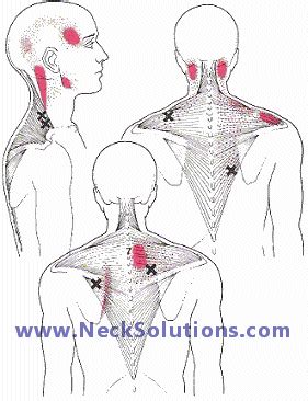 Some individuals experience only shoulder pain or only neck pain, while others experience pain in both areas. Pin on How To Try & Get Rid Of Back Pain!