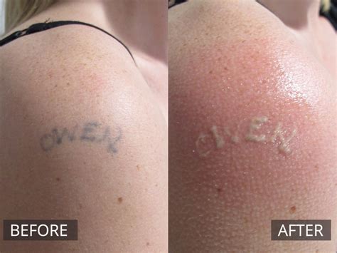 You're other treatments sounded down right scary. How To Remove A Tattoo With Laser - Wiki Tattoo