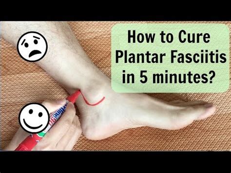 After needle insertion, have the patient walk (weight‑bear) for up to five minutes. The 5 minute plantar fasciitis solution stretch Jim ...