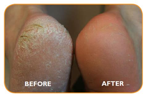 Maybe you would like to learn more about one of these? Callus Peel - Essense Aesthetic Beauty Clinic