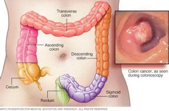 Signs and symptoms of hemorrhoids. End Stage Colon Cancer Timeline - Cancer News Update