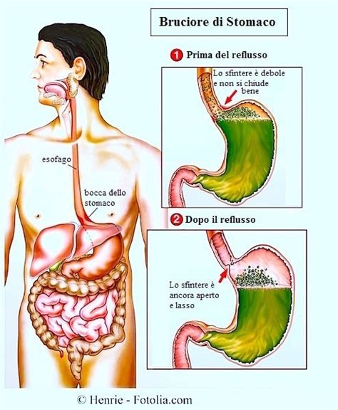 Seguire un'alimentazione a basso contenuto di grassi Esofagite da reflusso o eosinofila, cause, sintomi, cura ...