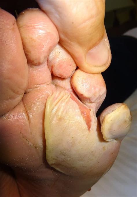 Maceration is defined as the softening and breaking down of skin resulting from prolonged exposure to moisture. Maceration Part 1: What Is Trench Foot | Blister Prevention