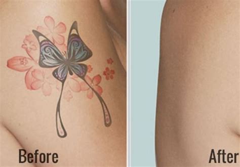 How to prevent infections and protect the ink from. Home Remedies for Tattoo Removal, Fading and Lightening ...