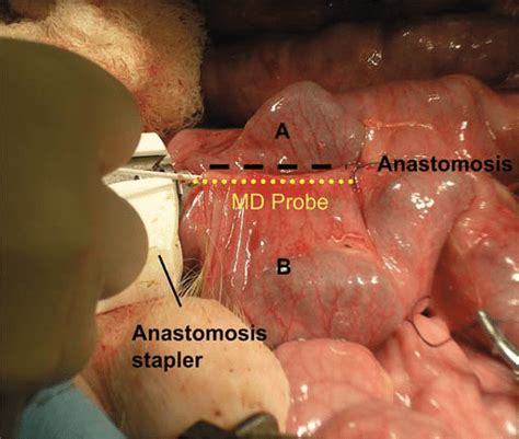 For injuries of the right colon, an ileocolostomy has a lower incidence of leakage than a colocolonic anastomosis. Microdialysis probe in the bowel of the animal model. Construction of... | Download Scientific ...