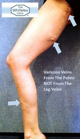 Defined by ovarian/pelvic varicose veins, chronic pelvic pain. Varicose Veins from the Pelvis - The Whiteley Clinic