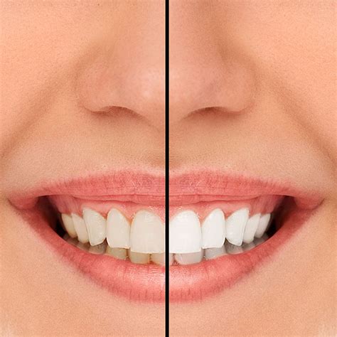 Are you uncertain of how to fix crooked teeth and where to get veneers in los angeles? How To Fix A Crooked Smile Without Surgery / Aside From ...