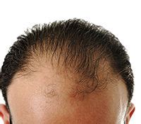 The treatment can take place at the regenix hair loss clinic in los angeles or in your own home. What is Regenix? Everything You Must Know About It ...