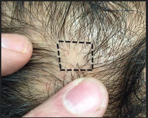 Or you may lose hair only in one area, which is called focal hair loss. Focal atrichia: A worrisome sign of AGA — Donovan Hair Clinic