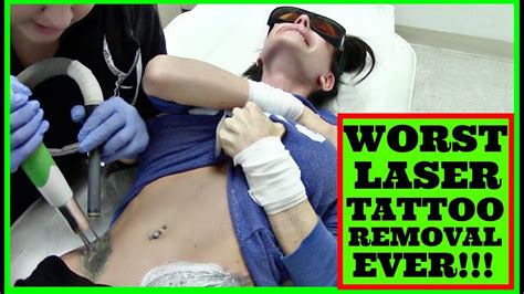 The world's largest gallery of real before and after laser tattoo removal photos currently more than 130 before and after photos of completely removed tattoos. WORST LASER TATTOO REMOVAL BEFORE & AFTER - YouTube