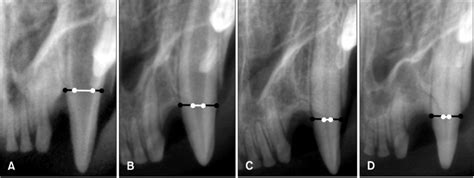 As long as the canine tooth's pulp isn't exposed, it won't be causing the cat discomfort. Radiographic images of feline canine teeth. Marked ...