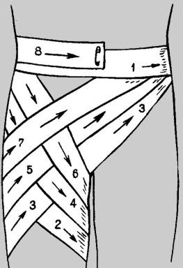 Использованные материалы необходимо убрать в пакет. Колосовидная повязка: показания и техника наложения ...