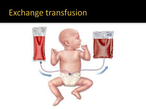 Exchange transfusion should always be discussed procedure for treating severe neonatal hyperbilirubinemia, the incidence of. PPT - Neonatal Jaundice ( Hyperbilirubinemia of The ...