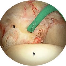 The fissures for ligamentum teres and ligamentum venosum indicate the junction between the medial and lateral parts of the left lobe. (PDF) Artroscopia cadera anatomia normal Normal Hip ...