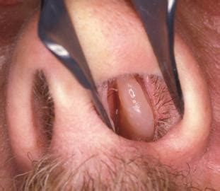 Minor nasal polyp question (self.nasalpolyps). ENT - Physician Assistant Pas5110 with Martin at South ...