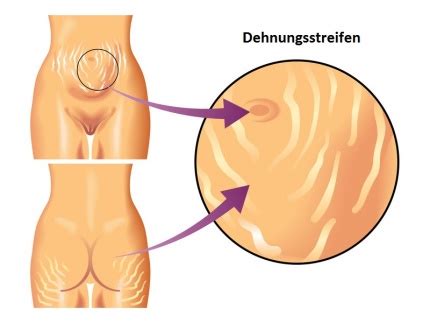 Dehnungsstreifen sind sehr unansehnlich, und manchmal kann das ganze ruinieren aussehen dieses knielangen kleides. Dehnungsstreifen - Ursachen, Behandlung & Vorbeugung ...