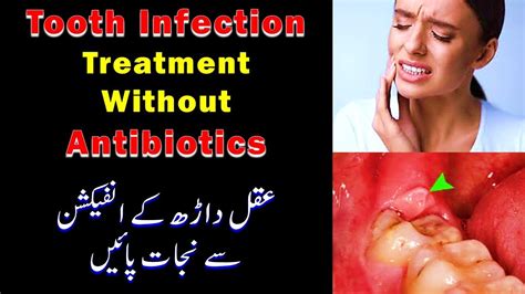 It is the most posterior of the three. ‫دانت کے انفیکشن کا علاج, Wisdom Teeth Infection Treatment ...