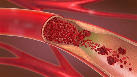 Reentrant svt, svt'li hastaların büyük çoğunluğunda görülür. Ist das eine Thrombose? | Hausarzt Medizin