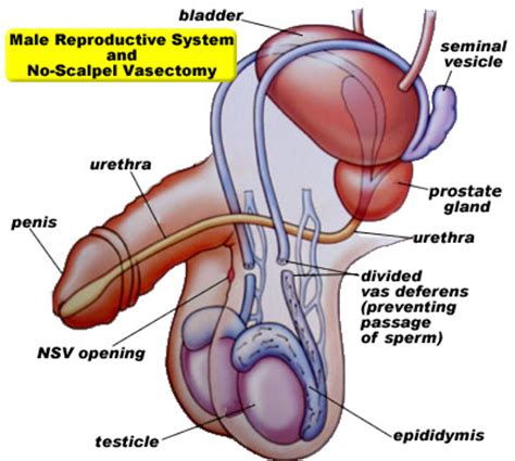 Now im having pelvic pain. Vasectomy and Male Infertility Center of Connecticut ...