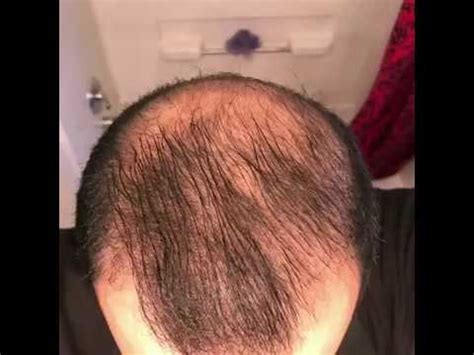 Allow the minoxidil to completely dry for 2 to 4 hours after applying it, including before going to bed. 5 months using minoxidil - Rogaine 5% Before & After ...