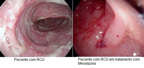 A retocolite ulcerativa tem seu diagnóstico a partir de sintomas como diarréia mucosanguinolenta e urgência fecal associados a uma inflamação da mucosa intestinal que costuma se iniciar no reto e atingir também os cólons. Mesalazina e Sulfasalazina no tratamento da Colite ...