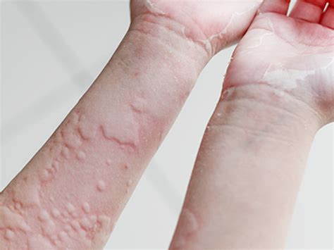 A csalánkiütés (urticaria) egy gyakori bőrtünet, a bőr középső rétegében, az irhában alakul ki, amely az erek. Csalánkiütés okai és kezelése - Budai Allergiaközpont