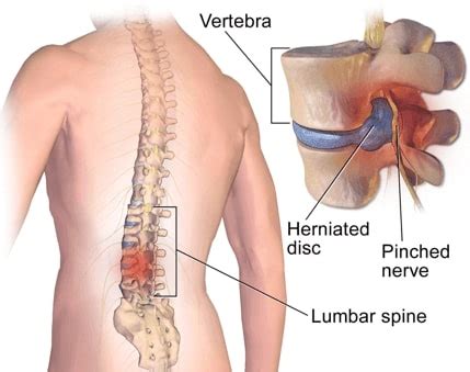 Why diverticulitis can cause aggravating low back pain. Lower Back Pain Treatment in NJ | Pain Management Doctor ...