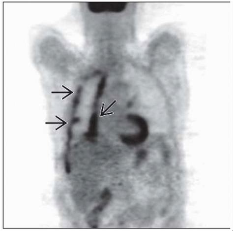 This system requires staging by use of ct or mr imaging, although surgical staging is considered superior when feasible. Mesothelioma | Radiology Key